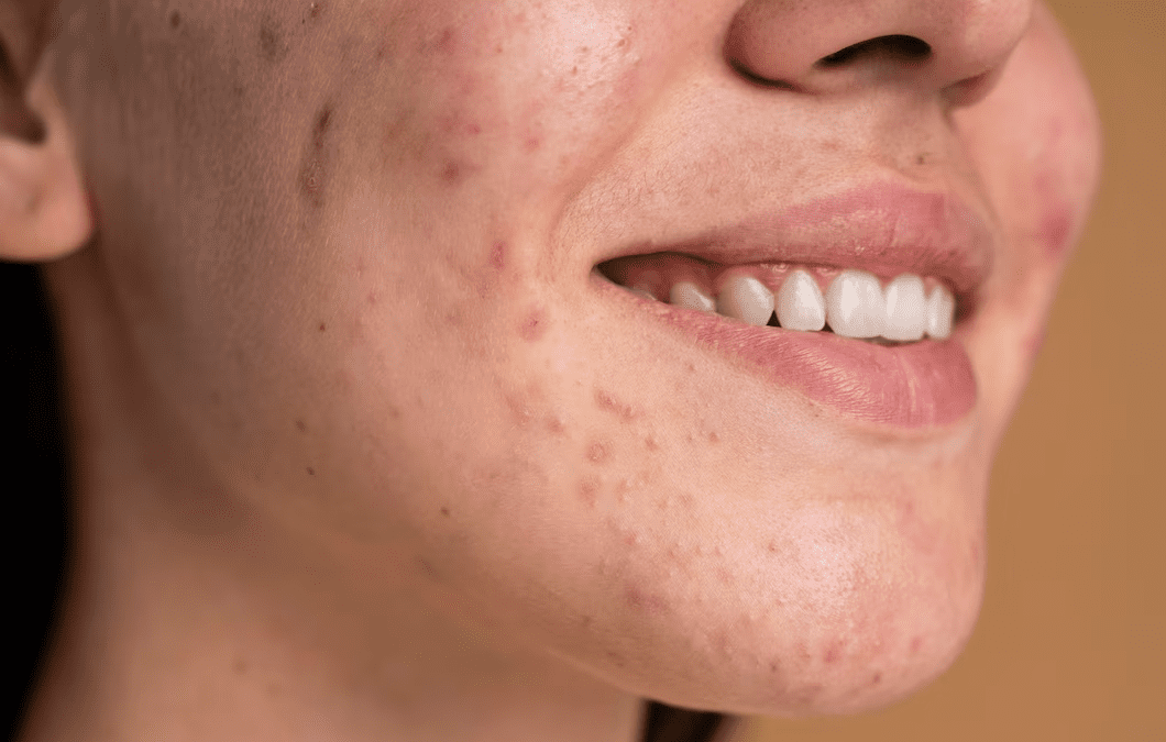 Effective Solutions for Treating Acne Scars in Vernon