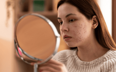 Effective Acne Treatments: What You Need to Know