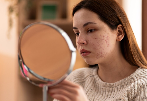 Effective Acne Treatments: What You Need to Know