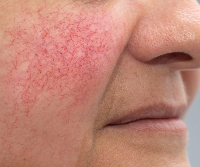 Rosacea