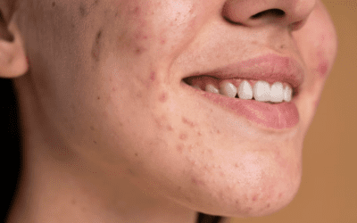 Effective Solutions for Treating Acne Scars in Vernon